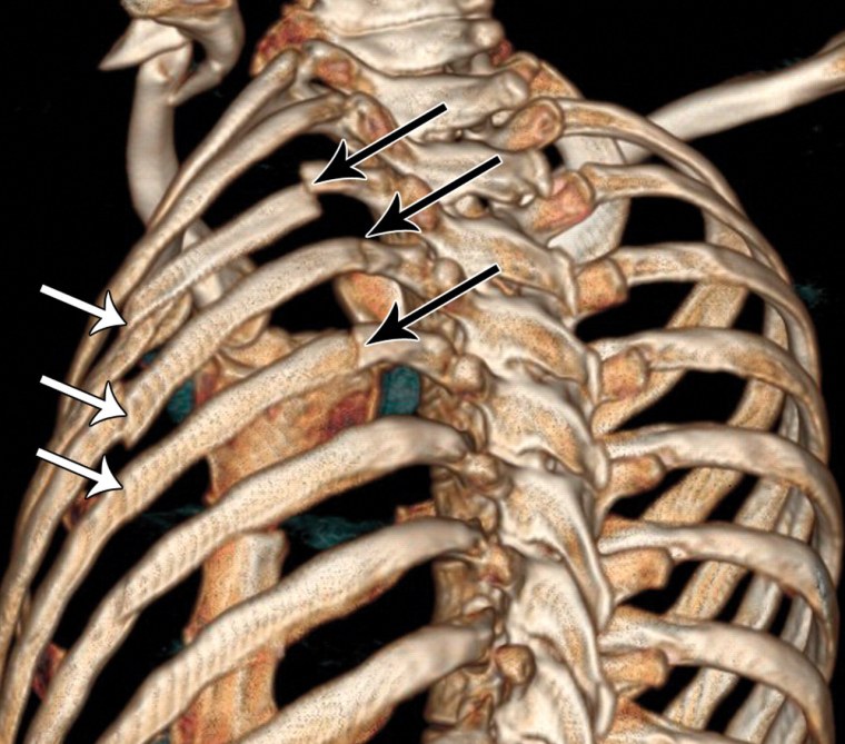 Неосложненный перелом ребра