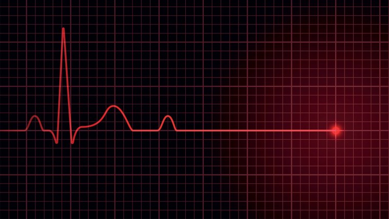 Остановка сердца на ЭКГ