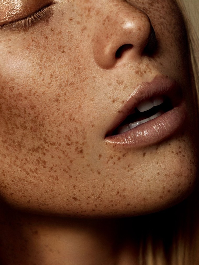 Кожа с веснушками