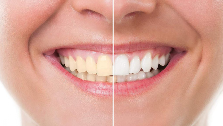 Стоматология отбеливание