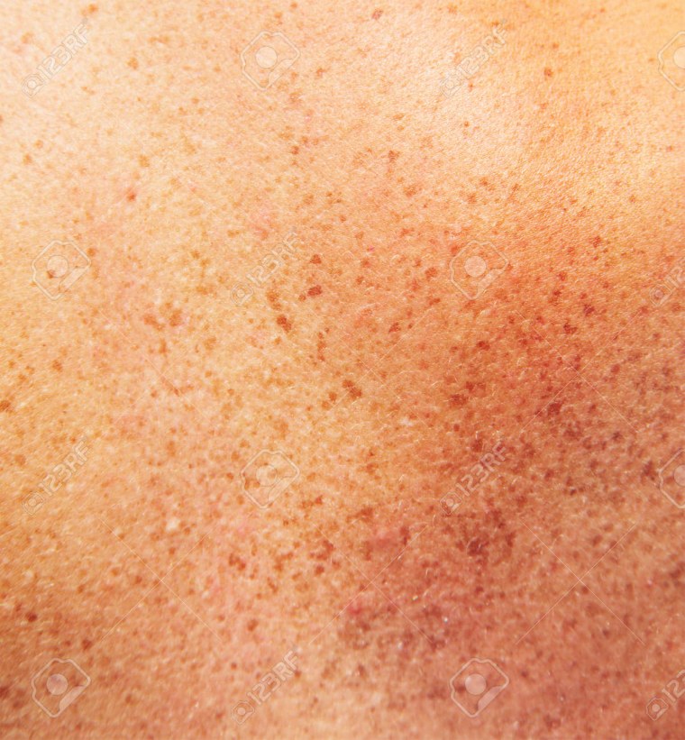 Кожа с веснушками текстура