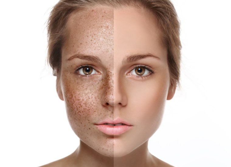 Гетерохромия глаз у людей