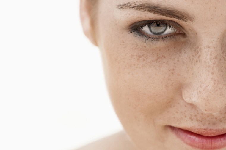 Здоровая кожа с веснушками