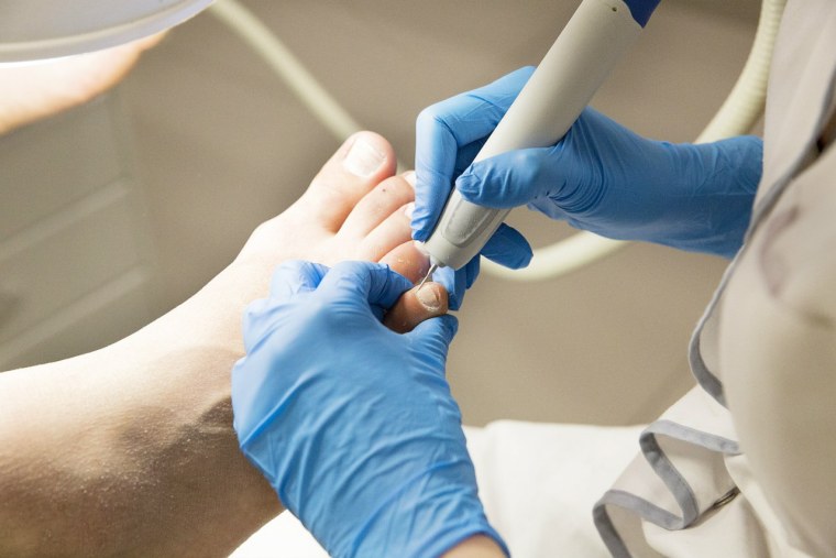 Тампонирование вросшего ногтя