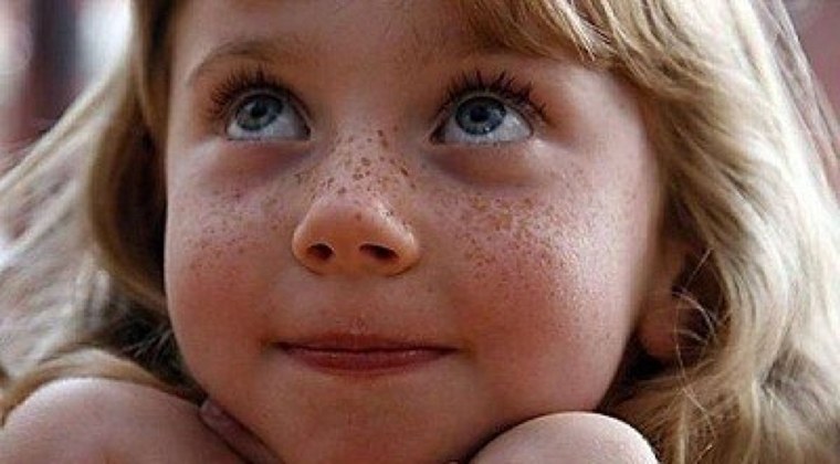 Веснушки эфелиды