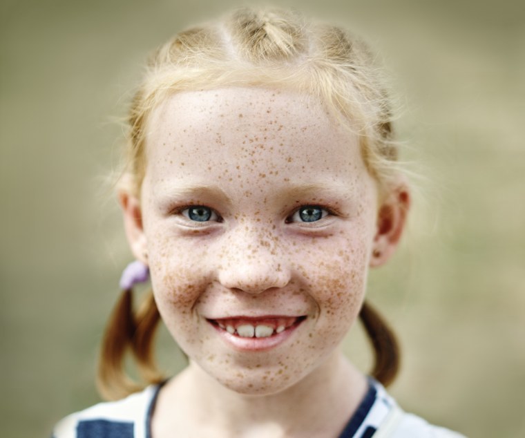 Конопушки у ребенка