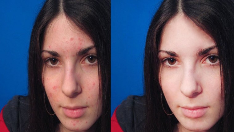 Лицо девушки с дефектами кожи