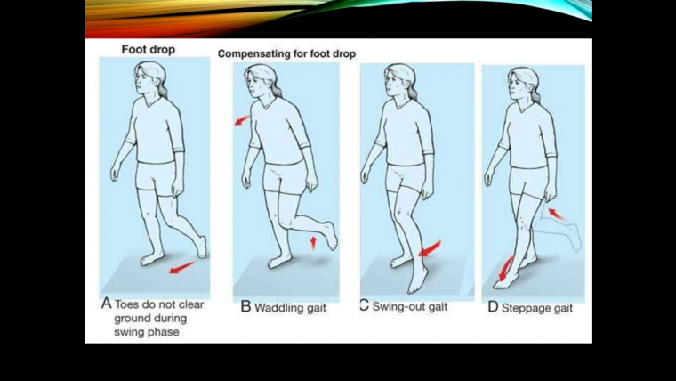 Походка степпаж